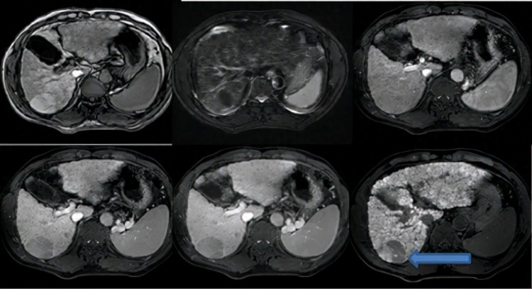 精准发现肝脏病变！云浮市人民医院影像科开展新型肝胆特异性对比剂MRI增强检查